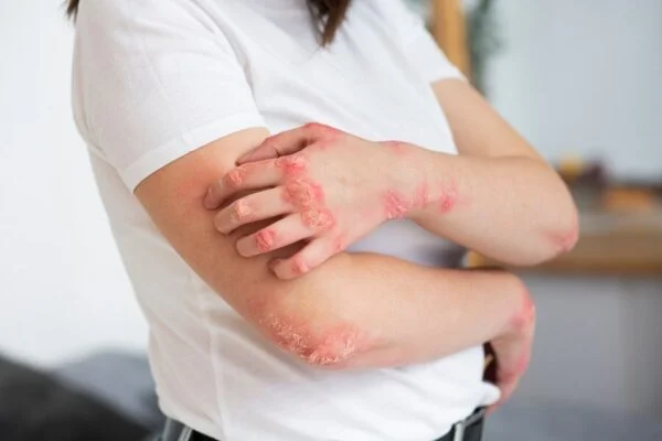 Psoriazis – Cauze, simptome și tratamente moderne